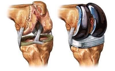 knee_joint_replacement_prosthesis